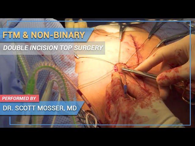 LIVE SURGERY of Transgender FTM/Non-Binary DOUBLE INCISION Top Surgery Performed by Dr. Mosser