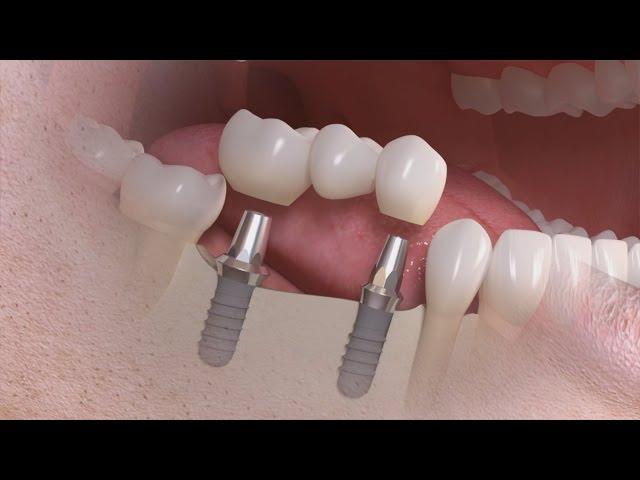 Straumann - Trattamento di più denti su impianto