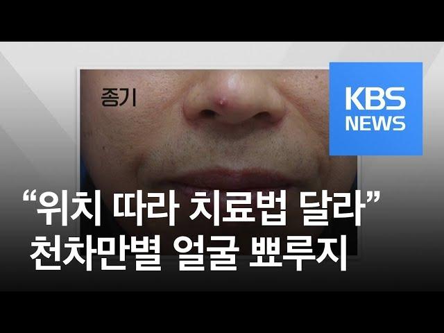 [5분 건강 톡톡] 얼굴 뾰루지도 천차만별…코밑 함부로 짜지 마세요! / KBS뉴스(News)