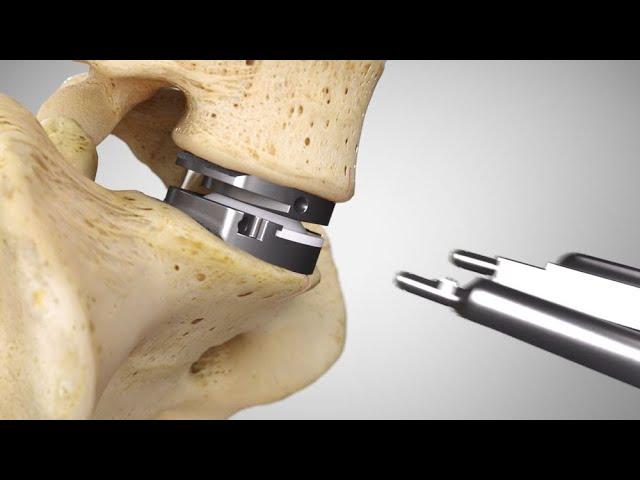 prodisc® L Surgical Technique Animation (2021) | Lumbar Total Disc Replacement | Disc Arthroplasty