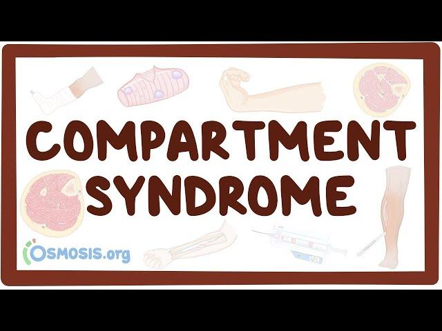 Compartment syndrome - an Osmosis Preview