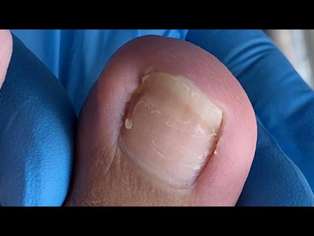 Step by step - how to cut ingrown nail by professional【辥一刀】