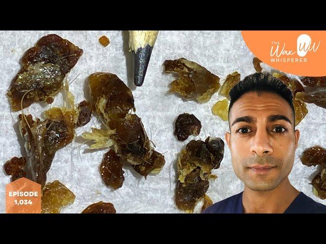 1,034 - Hardened Blocked Ear Wax & Keratin Removal