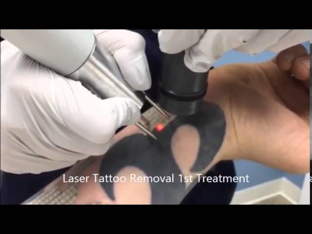 Laser Tattoo Removal Burke, VA @ Skin Deep Laser Services