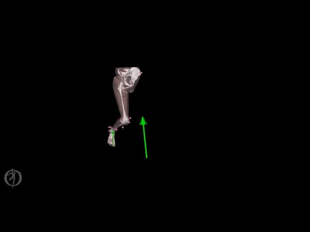 Personalised model of child with cerebral palsy walking