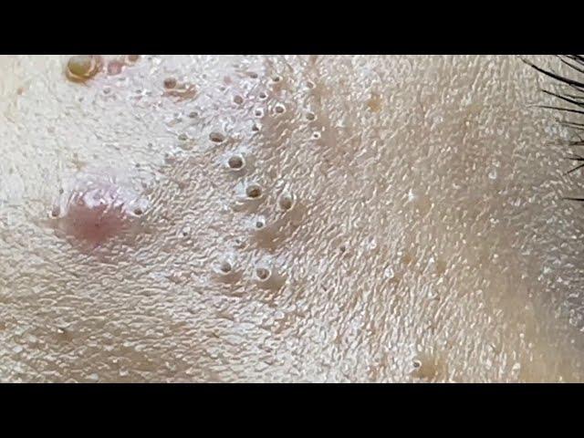 Acne treatment for Spa Linh Mun 2023 #045