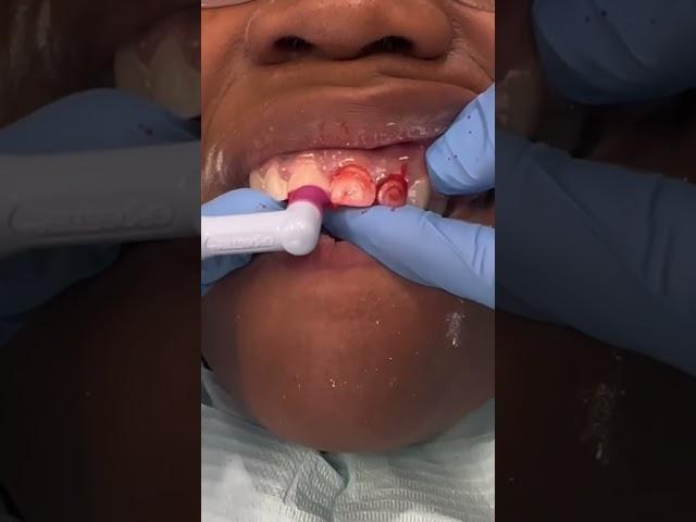 WHO HAS BRACES?! #shorts #bracesoff #orthodontist #shullmanorthodontics