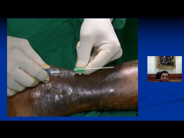 How to close Perforator Veins using Laser - Dr Shoaib Padaria