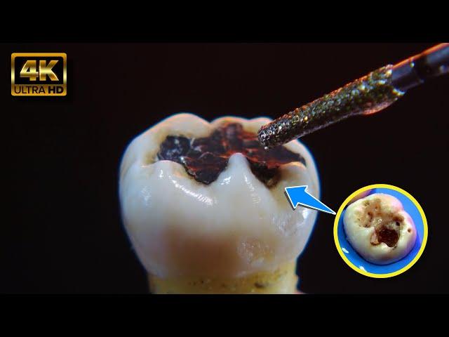 AMAZING process of dental restoration, step by step in 4K