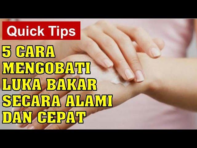 Cara Mengobati Luka Bakar | Cara Menghilangkan Bekas Luka Bakar