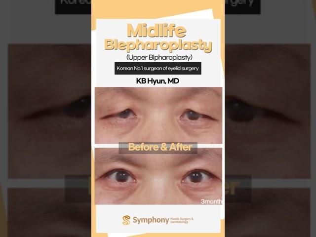 Middle aged Droopy eyelid surgery (Blepharoplasty, Lifting), which hospital should you choose?