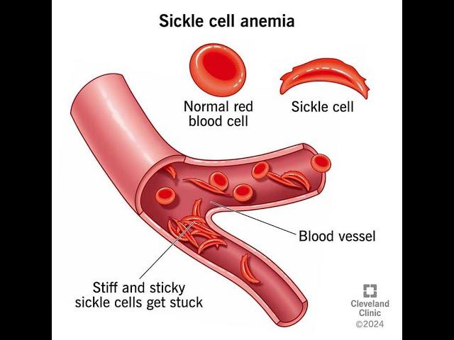 The Impact of Sickle Cell and How it affects Africans