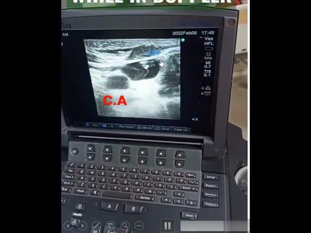 INTERNAL JUGUALR VEIN THROMBUS  -DOPPLER FINDING- WHILE INSERTING HD CATHETER