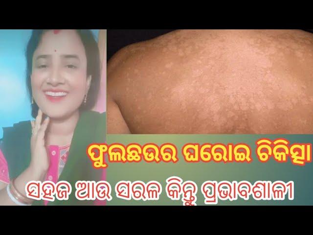 Home Treatment Of Tinea Versicolor{ଫୁଲଛଉର ଘରୋଇ ଚିକିତ୍ସା }@monisatipstricks