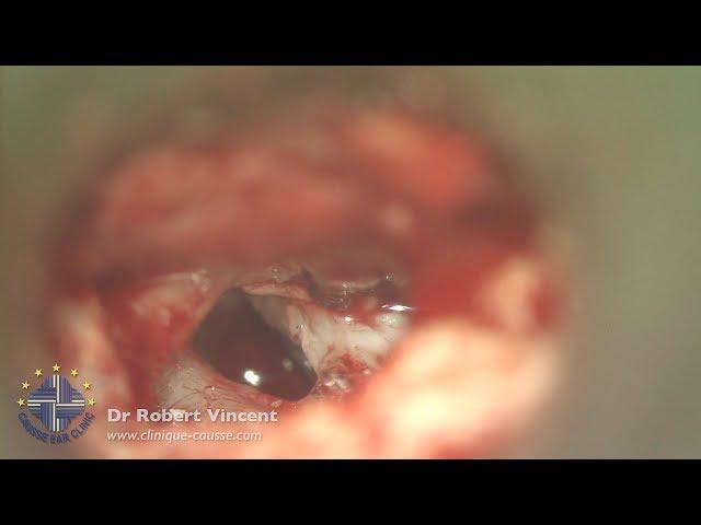 Revision Otosclerosis for Large Perilymph Fistula with Severe Dizziness