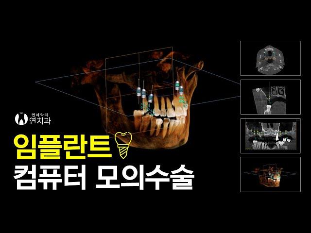컴퓨터 모의수술을 통한 네비게이션 임플란트압구정 연세닥터연치과의 디지털임플란트(Navigation Implant Through Computer Simulation Surgery)
