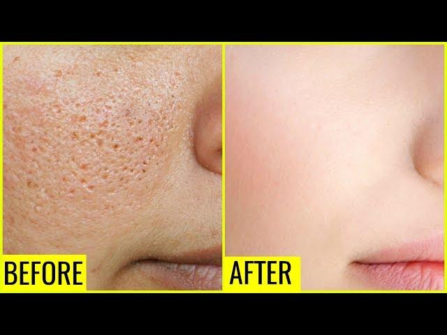 How to Get Rid of Large OPEN PORES Permanently | Anaysa