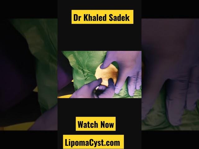 Bikini Line cysts are no fun. Dr Khaled Sadek. Full video online #cystremoval #blackheads #pimples
