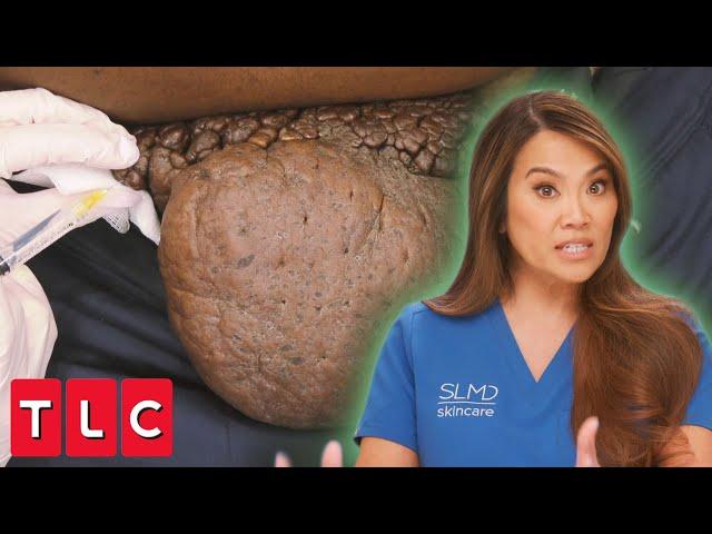 Dr. Lee Examines James' "Eye-Popping Bumps!" | Dr. Pimple Popper