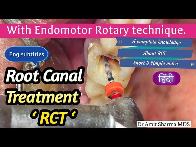 Root Canal Treatment step by step | on patient | RCT | रूट केनाल ट्रीटमेंट | Single visit RCT