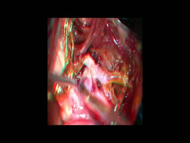 Clipping of Anterior Communicating Artery Aneurysm Post Endovascular Coiling: 3-D Mobile View
