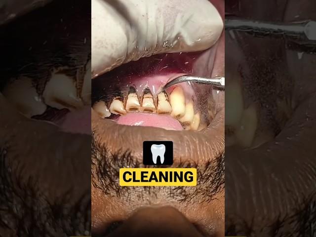 Pan - Smokers Teeth Cleaning #teethcleaning #dirtyteeth