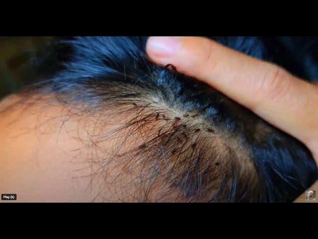 Picking a thousand of lice on hair   How to get rid of lice #hair #wigs  #skincare #satisfying