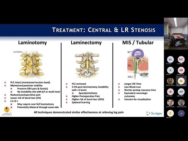 Neurogenic Claudication & Lateral Recess Stenosis : Rick Lang, MD on August 15, 2022.