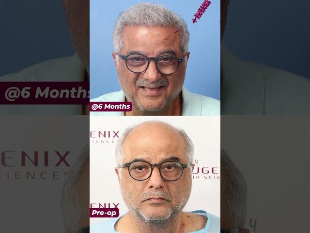 Producer Boney Kapoor's Hair Transplant 6 Months Results Update: Explained by Doctor