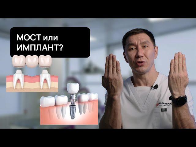 Мостовидный ПРОТЕЗ или ИМПЛАНТ? Какие последствия каждого выбора?