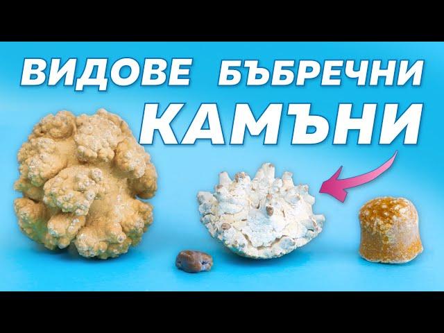 Кои са най-честите видове камъни в бъбреците?