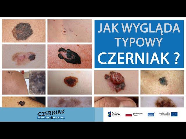 Jak wygląda typowy czerniak - złośliwy nowotwór skóry?