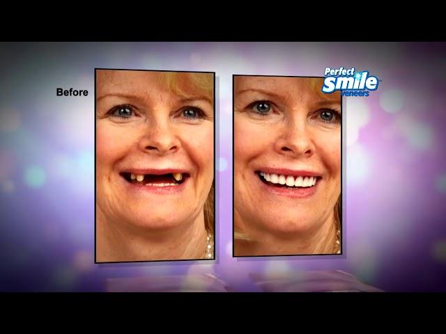 Perfect Smile Veneers