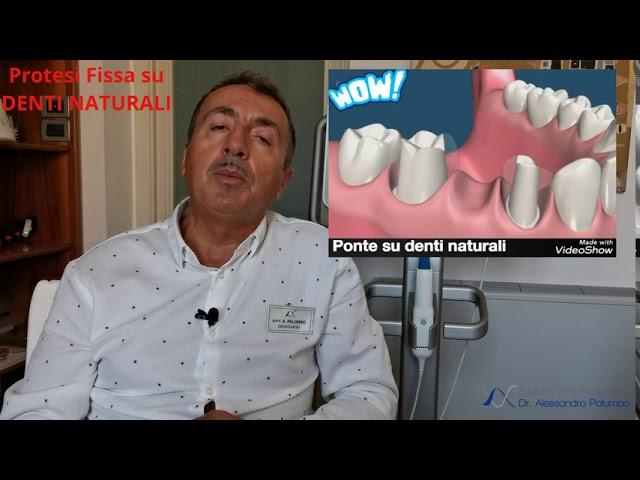 Protesi Fissa e Ponti su denti naturali