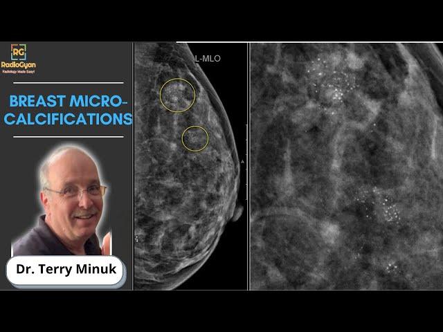 Mastering Mammography: Understanding Breast Micro-calcifications | Dr. Terry Minuk