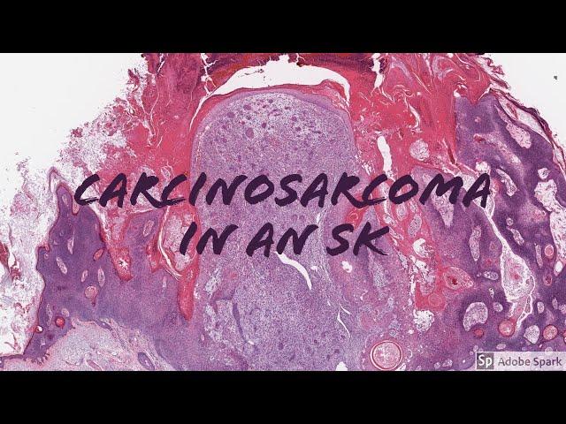 Carcinosarcoma Arising from Seborrheic Keratosis