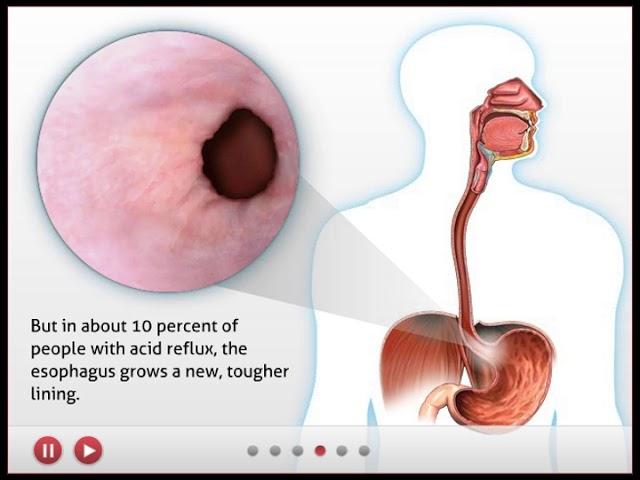 Barrett's esophagus - tutorial