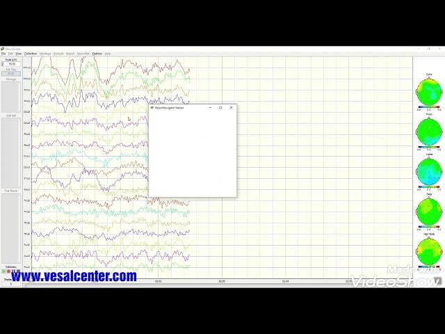 Detect ASD by qEEG