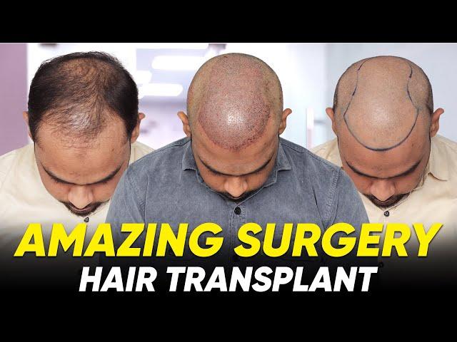 Hair Transplant in Saharanpur | Best Results & Cost of Hair Transplant in Saharanpur