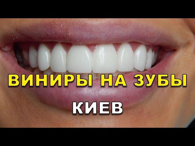 Виниры в Киеве. Видео - Виниры для зубов в клиниках ЛюмиДент (вініри)