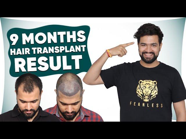 Hair Transplant in Jaipur | Best Results & Cost of Hair Transplant in Jaipur (HX -Vr6V)