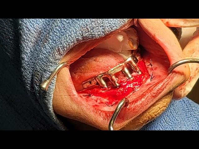 Vestibuloplasty DFI July 7th 2023 Highlight video