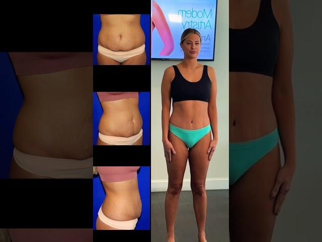 Dr Farber explains his Halo Lift Body Contouring Procedure. #beforeandafter #plasticsurgeon