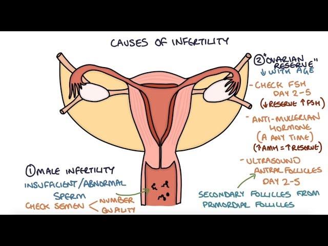 Understanding Infertility Causes and Investigations