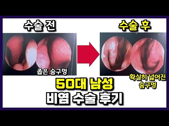 50대 남성 비염 수술후기