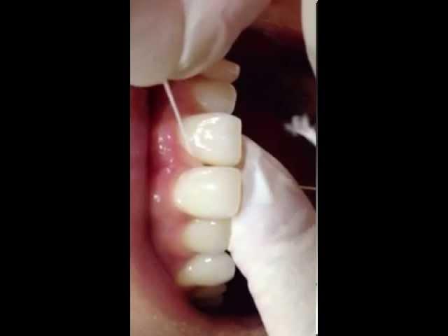 [brainspec] Dental Floss 치실 사용법_ohcshop_칫솔질방법