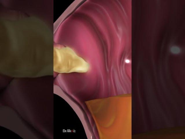 What Is Acid Reflux (Animation)