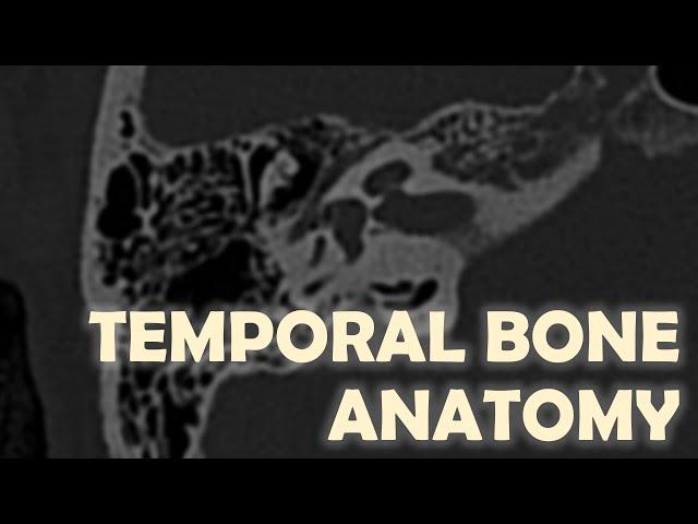 Anatomy of the Temporal Bone on Imaging