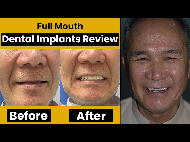 Full Mouth Dental Implants Before And After Review From Germany | Dr. Shahzad Mirza