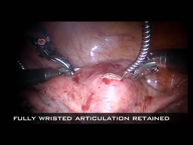 Robotic Myomectomy with the OmniGuide CO2 Laser Fiber System